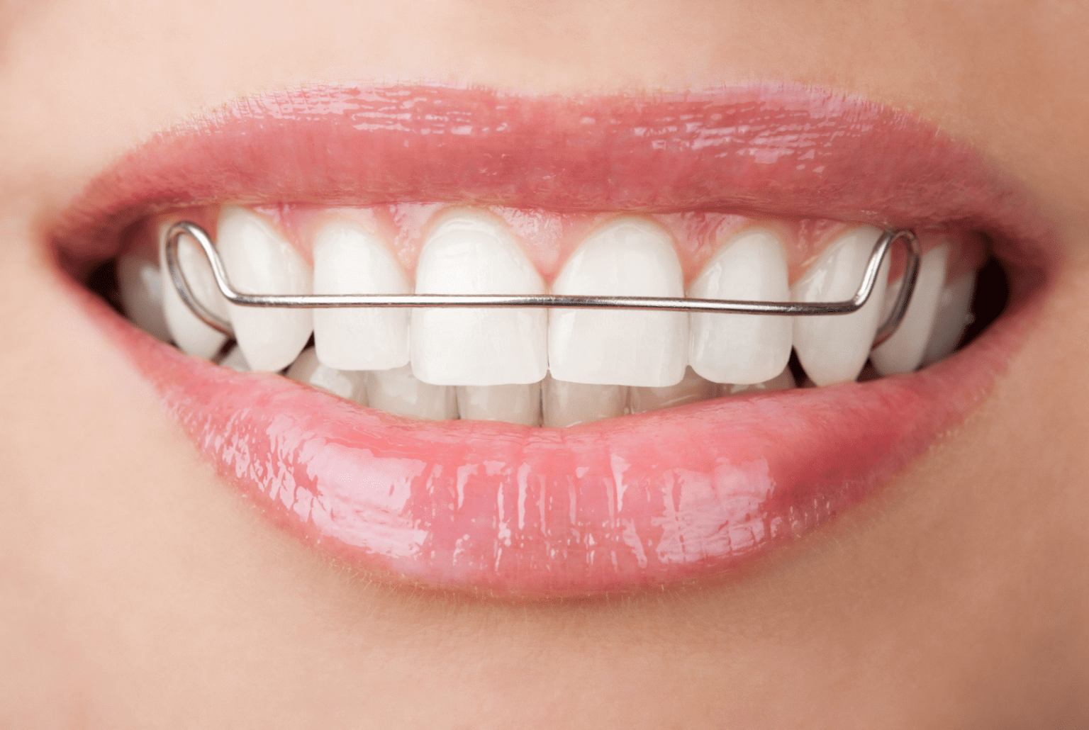 Close-up of a smile wearing a Hawley wire retainer